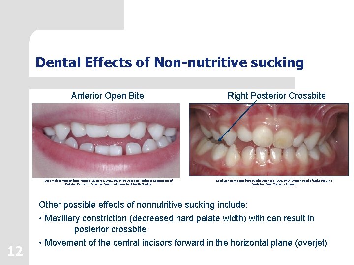 Dental Effects of Non-nutritive sucking Anterior Open Bite Used with permission from Rocio B.