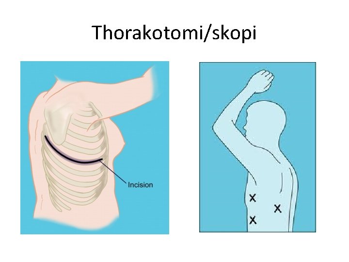 Thorakotomi/skopi 