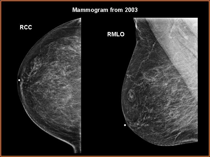 Mammogram from 2003 RCC RMLO 