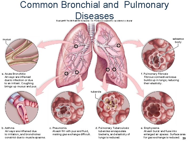 Common Bronchial and Pulmonary Diseases Copyright © The Mc. Graw-Hill Companies, Inc. Permission required