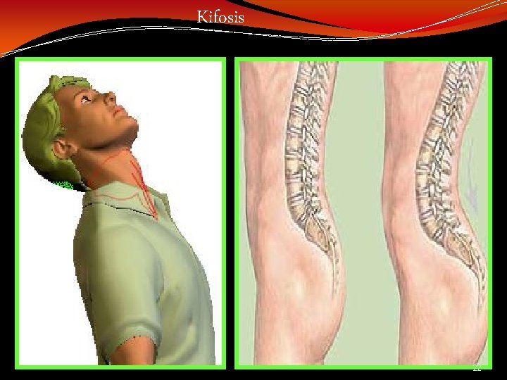 Kifosis 22 Kifosis 22