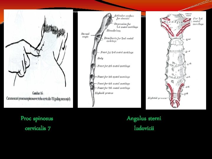 Proc spinosus cervicalis 7 Angulus sterni ludovicii 