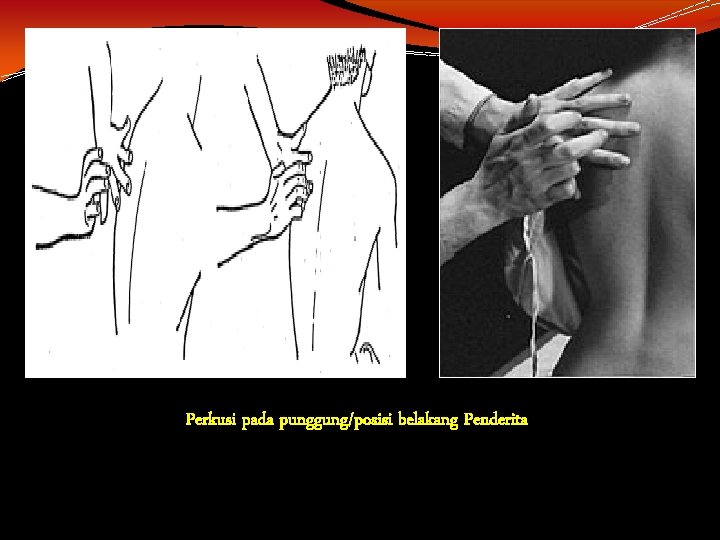 Perkusi pada punggung/posisi belakang Penderita Perkusi pada punggung/posisi belakang Penderita