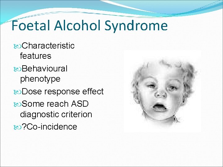 Foetal Alcohol Syndrome Characteristic features Behavioural phenotype Dose response effect Some reach ASD diagnostic