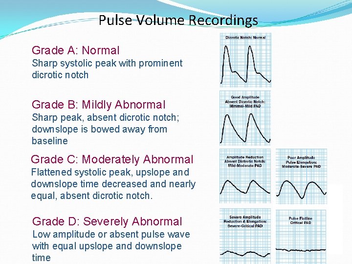 Pulse Volume Recordings Grade A: Normal Sharp systolic peak with prominent dicrotic notch Grade