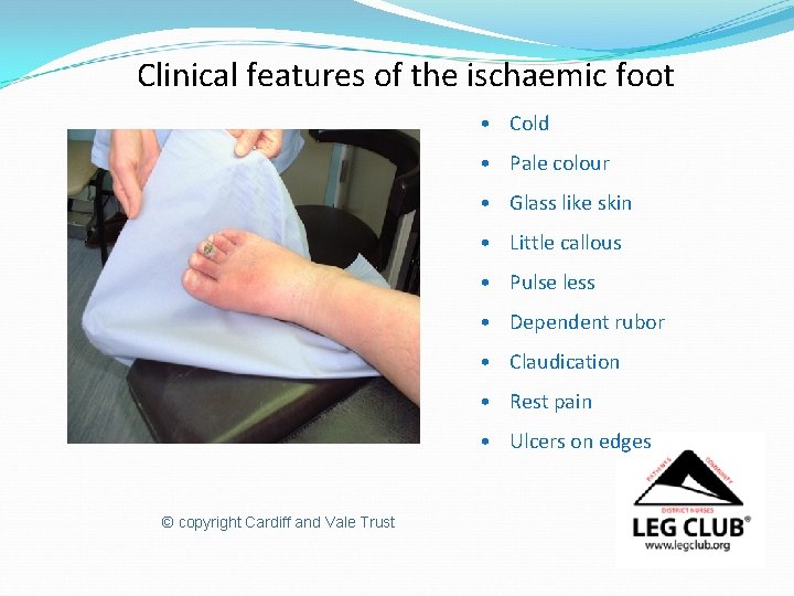 Clinical features of the ischaemic foot • Cold • Pale colour • Glass like