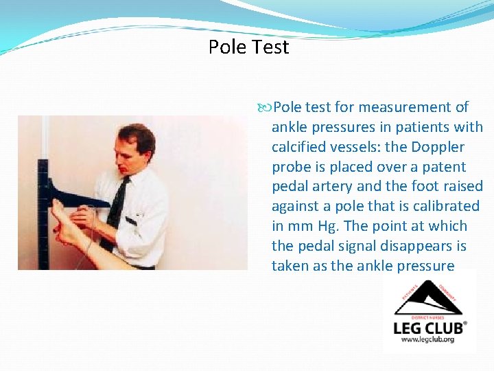 Pole Test Pole test for measurement of ankle pressures in patients with calcified vessels: