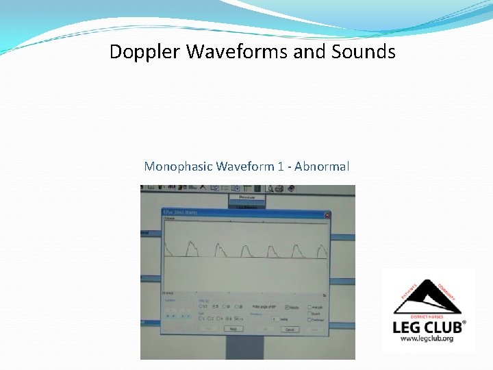 Doppler Waveforms and Sounds Monophasic Waveform 1 - Abnormal 