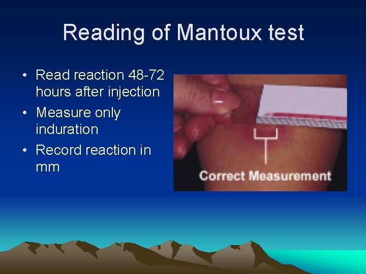 Reading of Mantoux test • Read reaction 48 -72 hours after injection • Measure