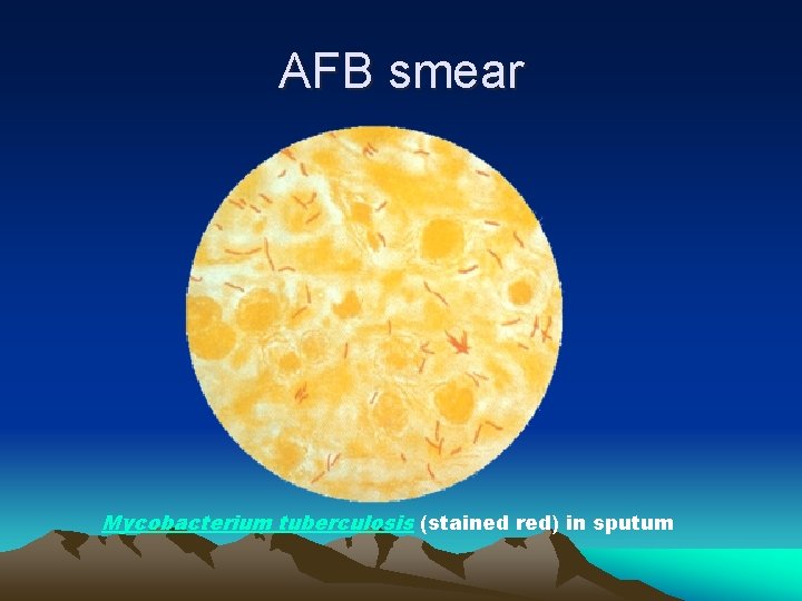 AFB smear Mycobacterium tuberculosis (stained red) in sputum 