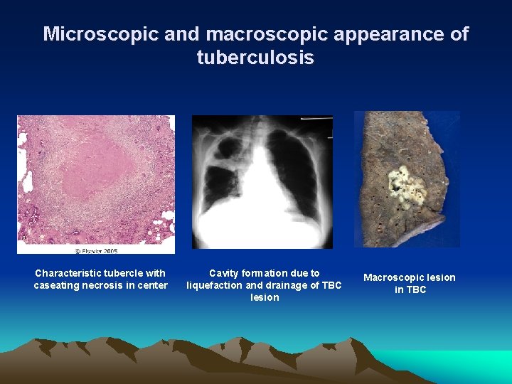 Microscopic and macroscopic appearance of tuberculosis Characteristic tubercle with caseating necrosis in center Cavity