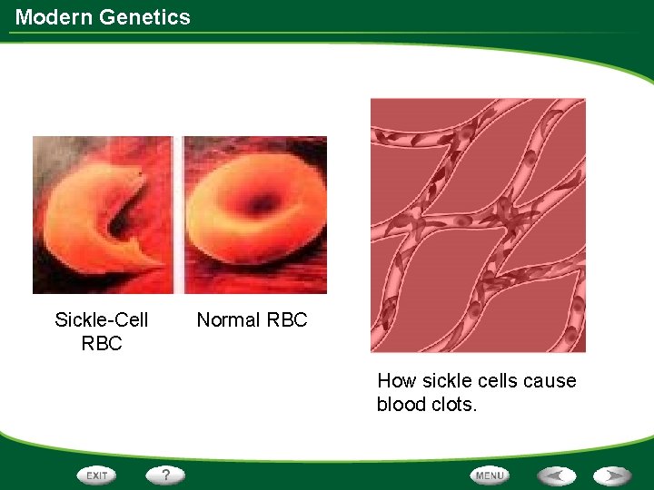 Modern Genetics Sickle-Cell RBC Normal RBC How sickle cells cause blood clots. 