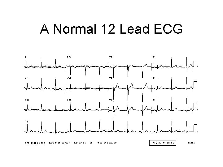 A Normal 12 Lead ECG 