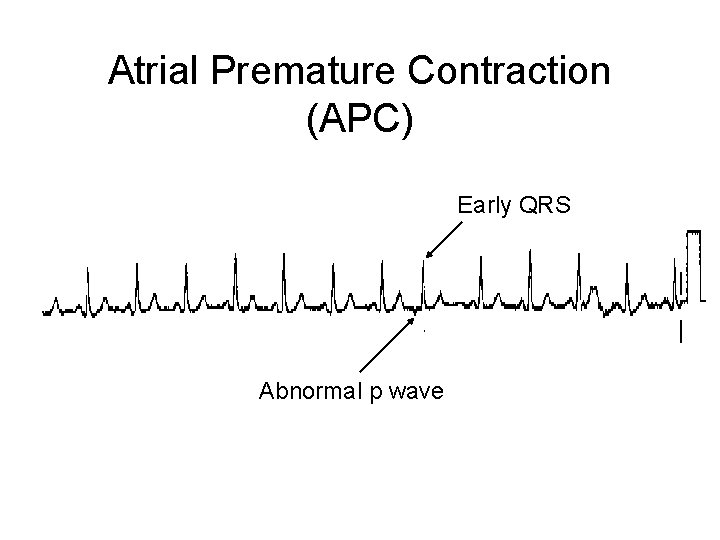 Atrial Premature Contraction (APC) Early QRS Abnormal p wave 