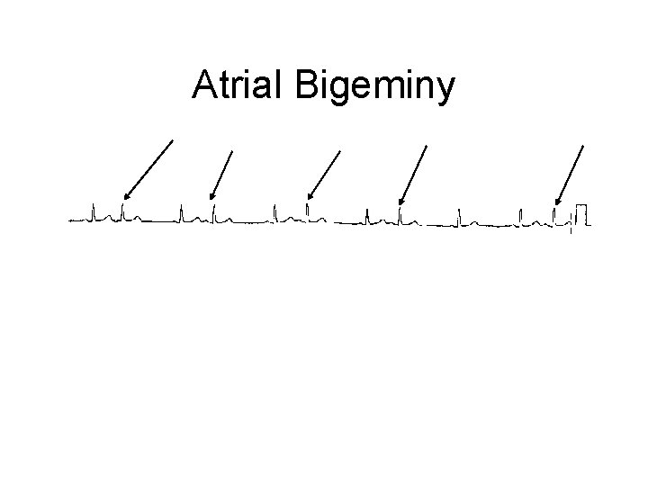 Atrial Bigeminy 