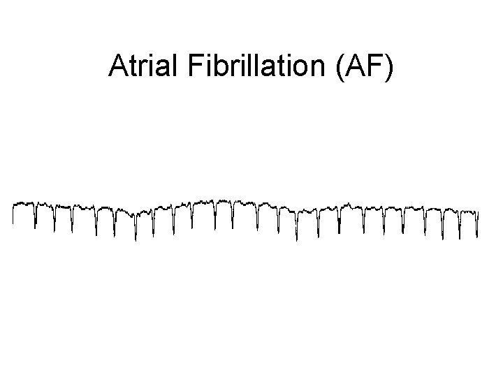 Atrial Fibrillation (AF) 