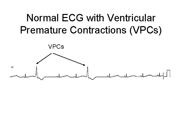 Normal ECG with Ventricular Premature Contractions (VPCs) VPCs 