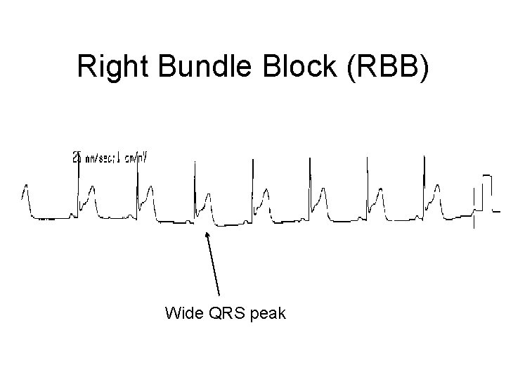 Right Bundle Block (RBB) Wide QRS peak 