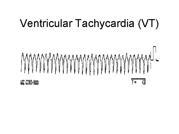 Ventricular Tachycardia (VT) 
