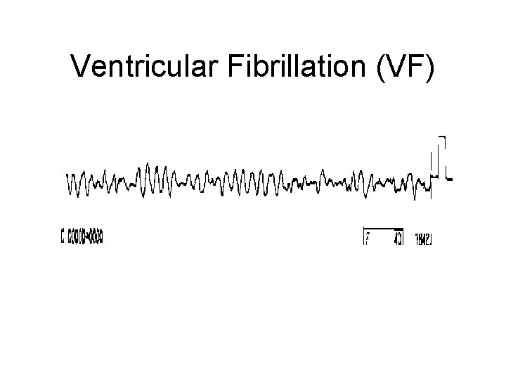 Ventricular Fibrillation (VF) 