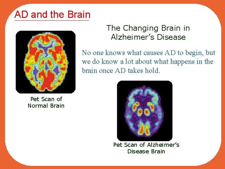 AD and the Brain The Changing Brain in Alzheimer’s Disease No one knows what