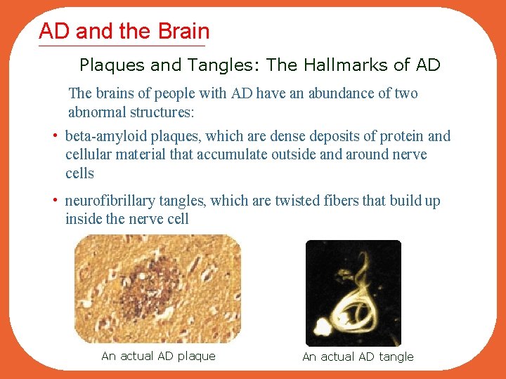 AD and the Brain Plaques and Tangles: The Hallmarks of AD The brains of