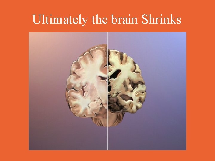 Ultimately the brain Shrinks 