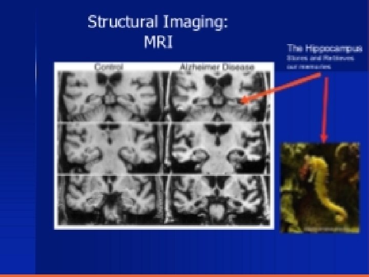 Structural imaging MRI 