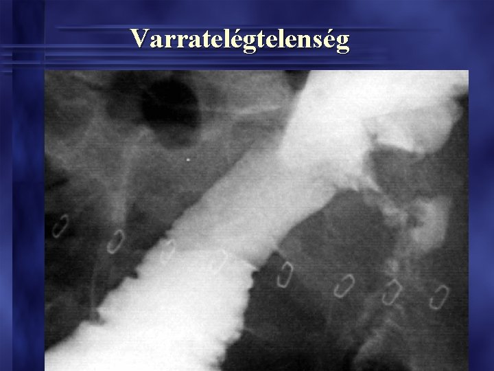 Varratelégtelenség Varratelégtelenség