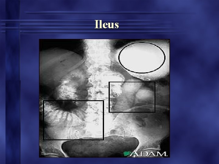 Ileus Ileus