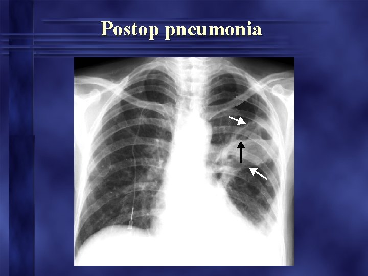 Postop pneumonia 