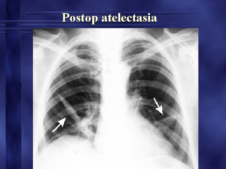 Postop atelectasia Postop atelectasia