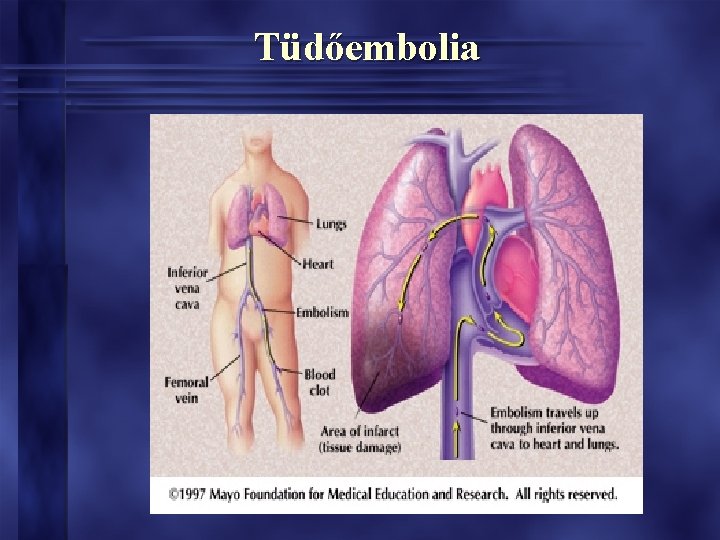 Tüdőembolia 