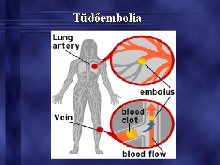 Tüdőembolia Tüdőembolia