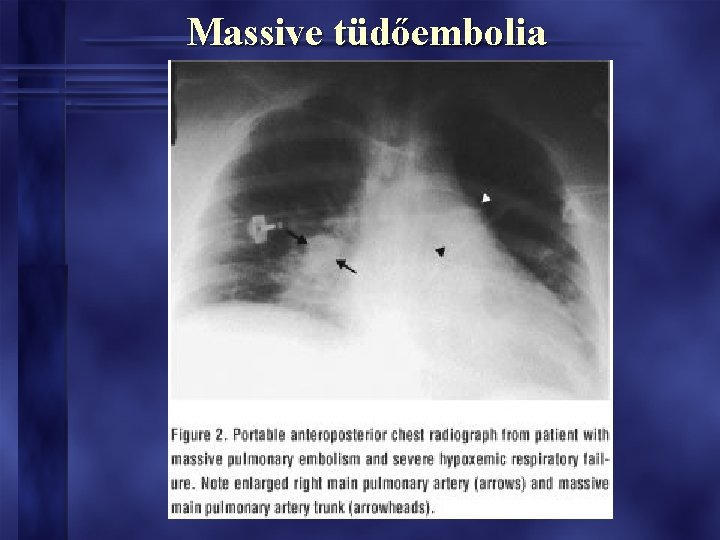 Massive tüdőembolia Massive tüdőembolia