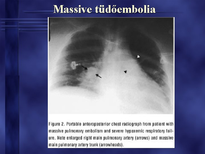 Massive tüdőembolia 