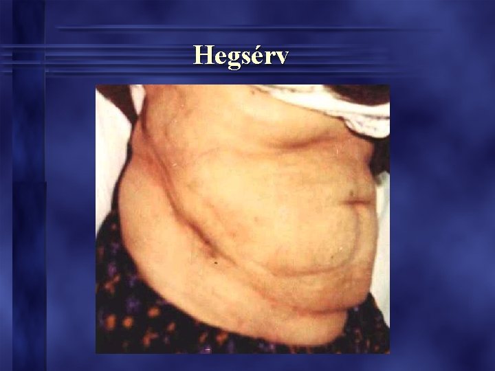 Hegsérv Hegsérv