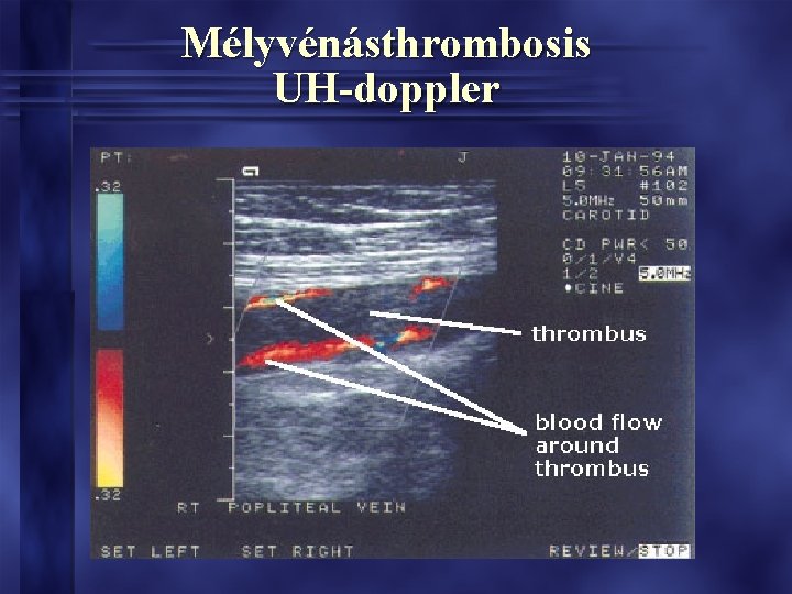 Mélyvénásthrombosis UH-doppler Mélyvénásthrombosis UH-doppler