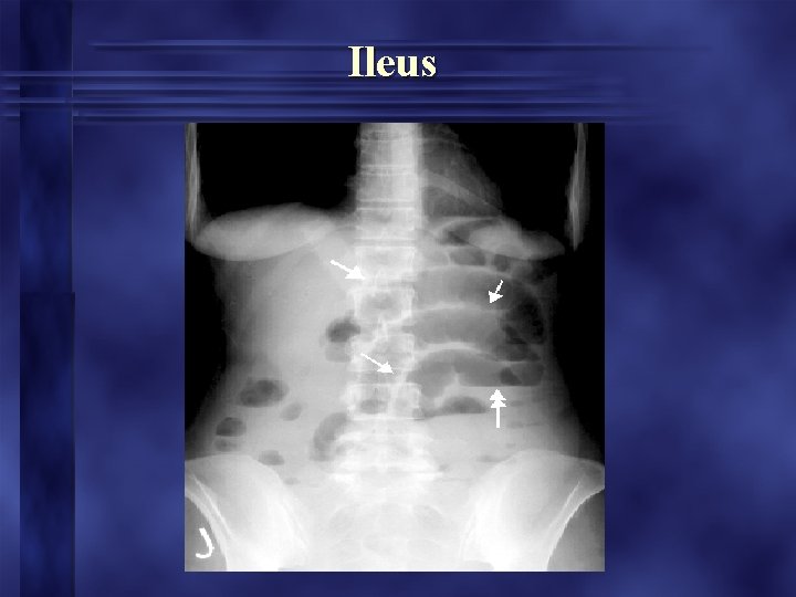 Ileus Ileus