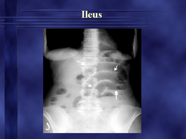 Ileus 