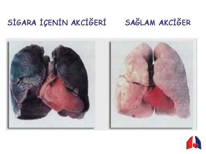 SİGARA İÇENİN AKCİĞERİ SAĞLAM AKCİĞER 