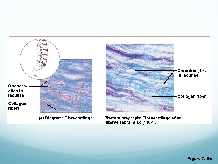 Chondrocytes in lacunae Chondrocites in lacunae Collagen fibers (c) Diagram: Fibrocartilage Photomicrograph: Fibrocartilage of