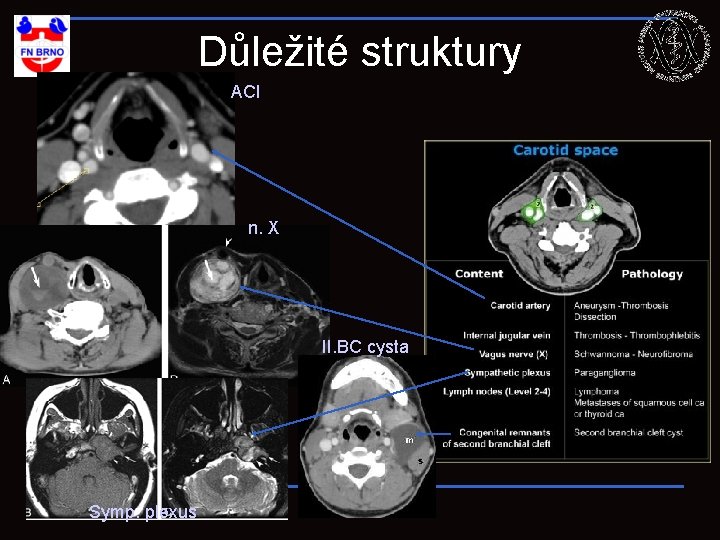 Důležité struktury ACI n. X II. BC cysta Symp. plexus 