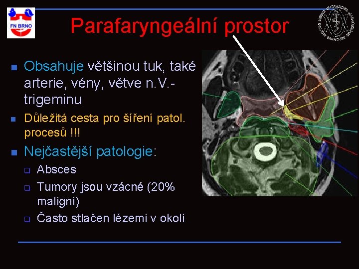 Parafaryngeální prostor n n n Obsahuje většinou tuk, také arterie, vény, větve n. V.