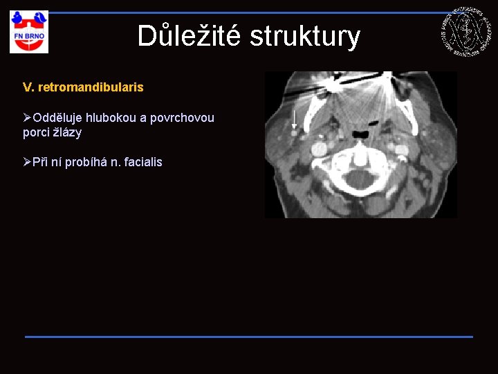 Důležité struktury V. retromandibularis ØOdděluje hlubokou a povrchovou porci žlázy ØPři ní probíhá n.