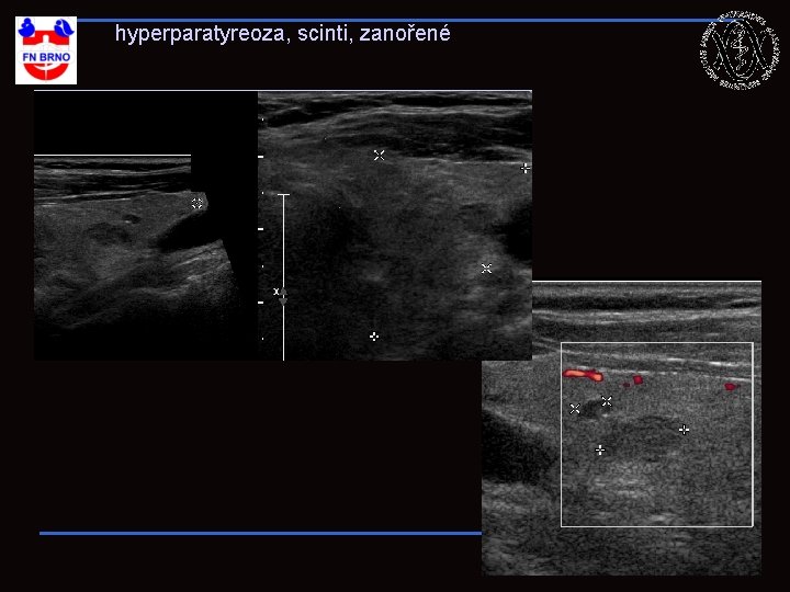 hyperparatyreoza, scinti, zanořené 