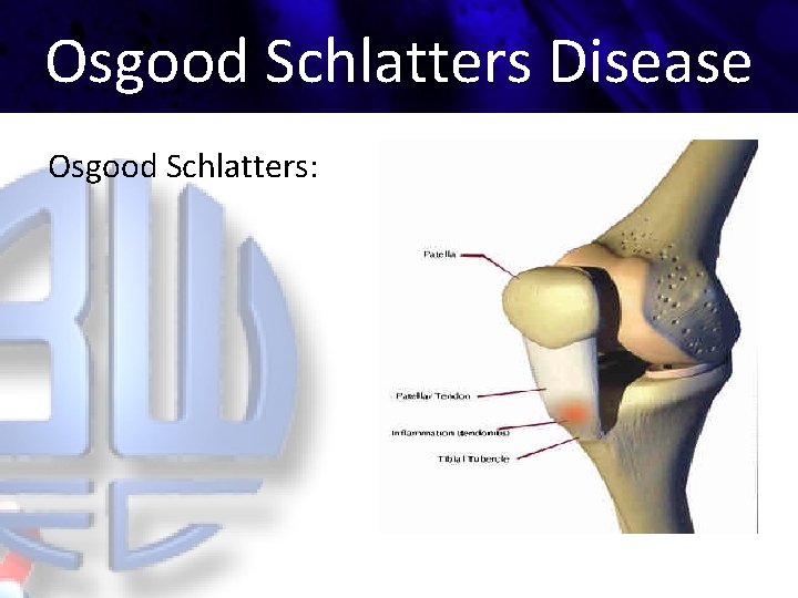 Osgood Schlatters Disease Osgood Schlatters: 
