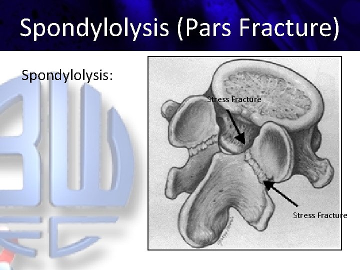 Spondylolysis (Pars Fracture) Spondylolysis: Stress Fracture 