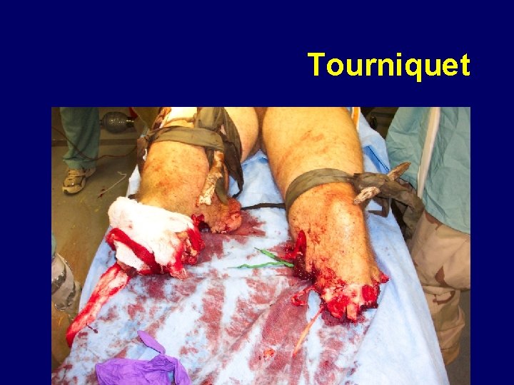 Tourniquet 