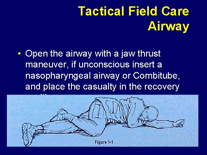 Tactical Field Care Airway • Open the airway with a jaw thrust maneuver, if